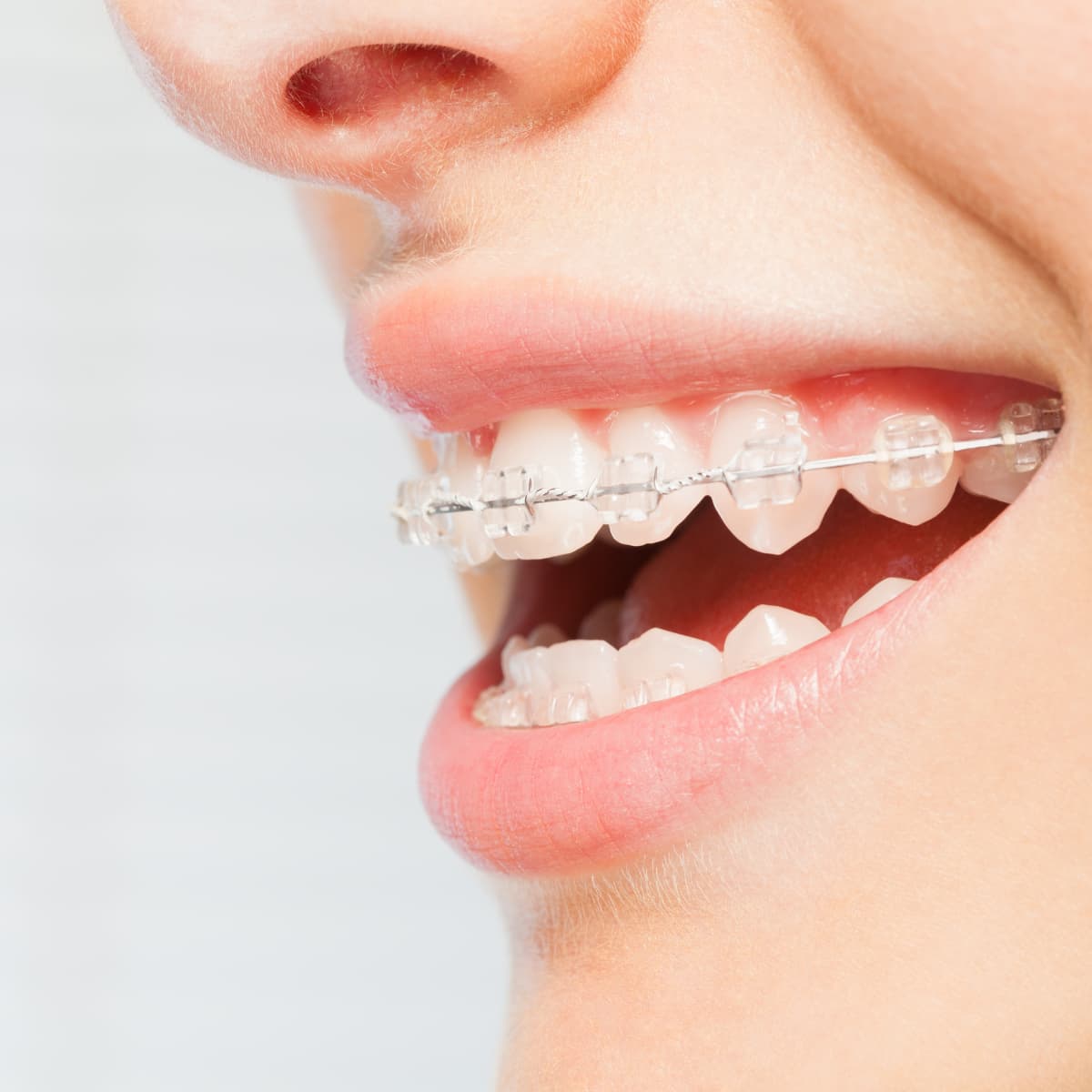 Sonrisa con brackets de zafiro