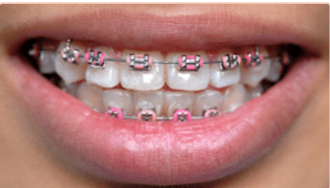 Sonrisa con brackets metálicos