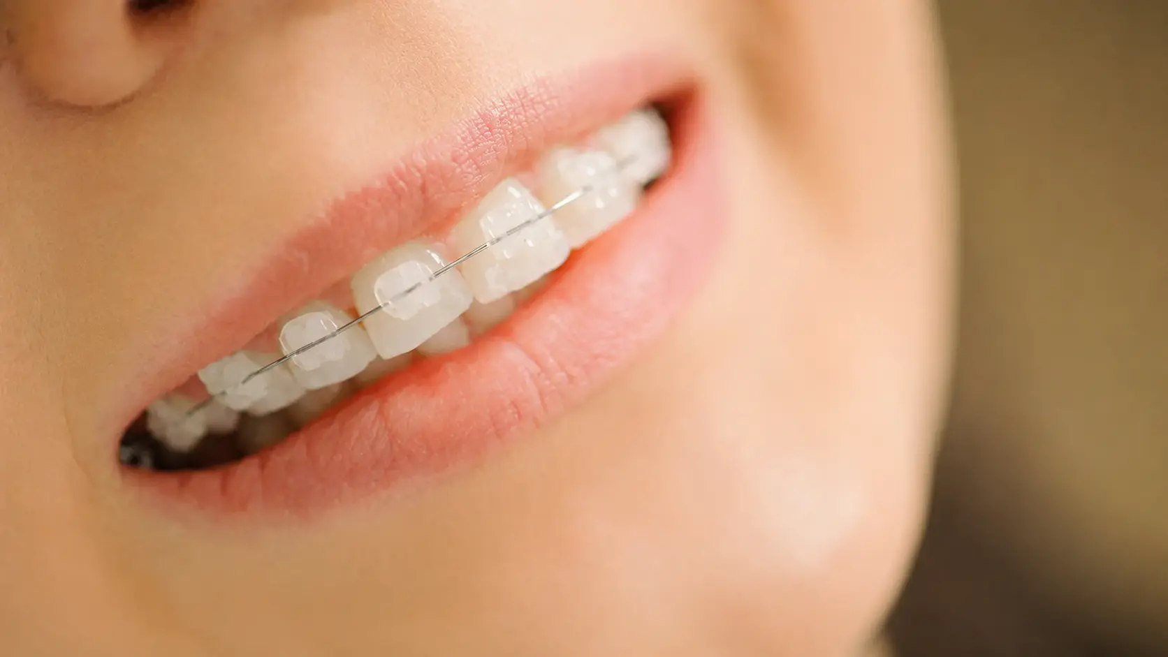 Sonrisa con brackets estéticos de cerámica