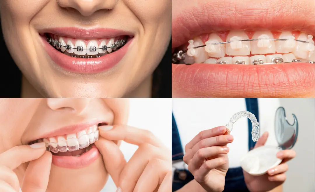 Opciones de ortodoncia invisible: brackets estéticos, brackets metálicos y alineadores transparentes